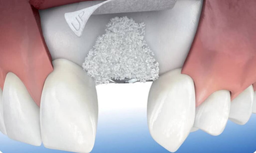 Periodontal Tedaviler için Flep Operasyonları
