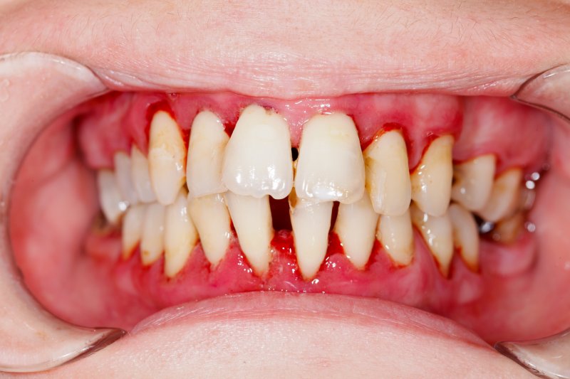 Periodontitis