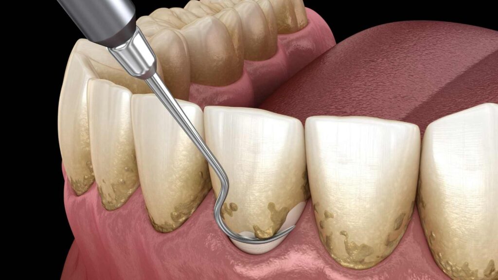 Subgingival Küretaj