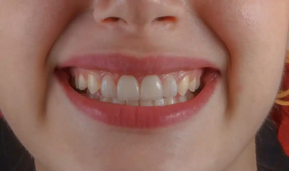 Diş Eti Gülümseme Tedavileri