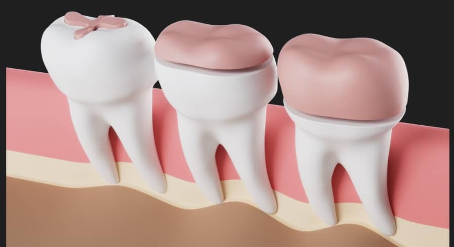 Inley ve Onlay Estetik Dolgular